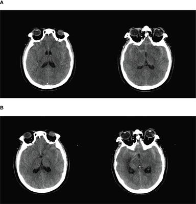 Case report: Low-dose radiation-induced meningioma with a short latency period